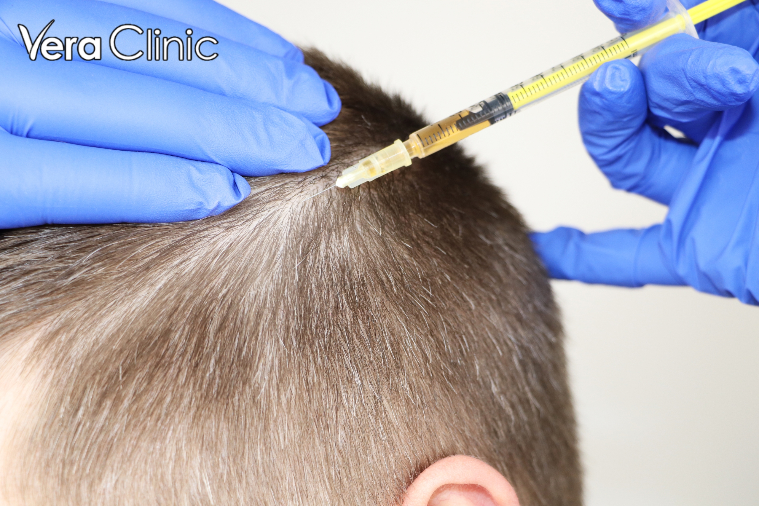 best hair transplant in turkey