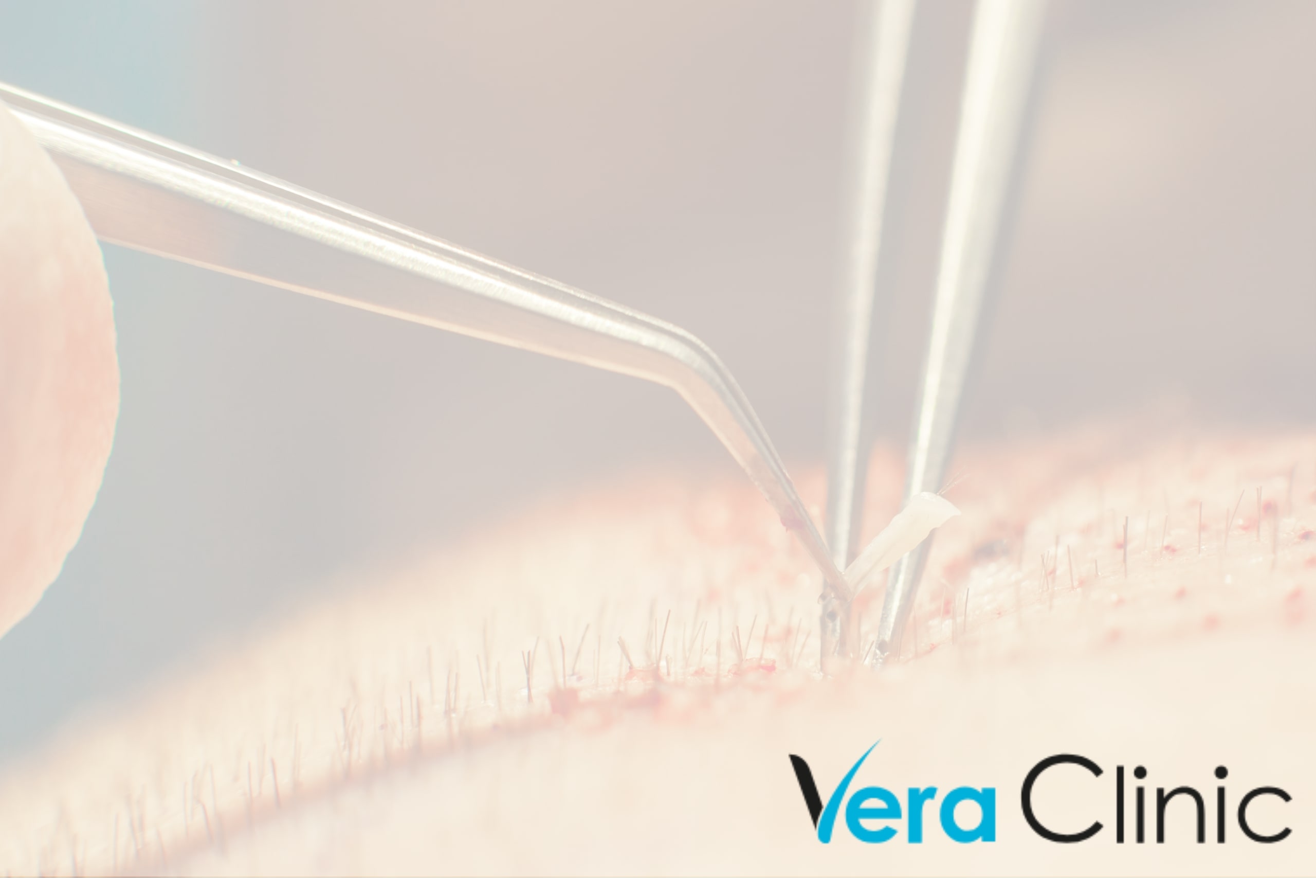 Ensuring Patient Safety And Satisfaction: Quality Care at Turkey’s Premier Hair Transplant Clinics